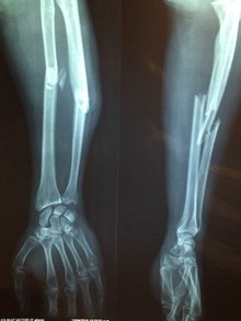 手骨骨折X光片图片下载